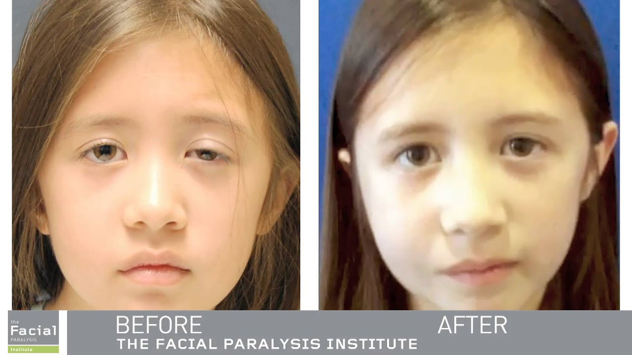 before and after blepharoplasty