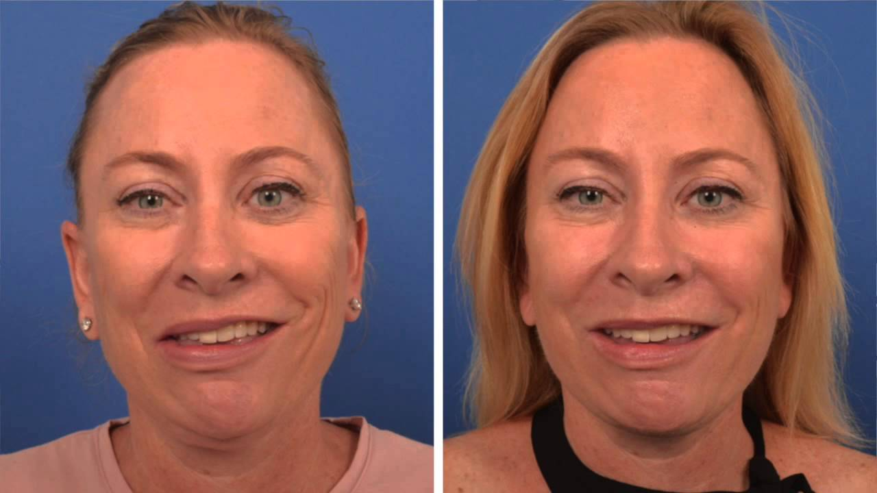 facial paralysis treatment