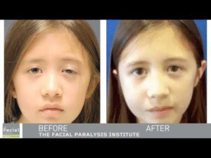  little girl with facial paralysis
