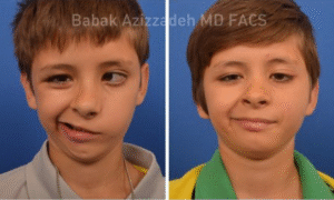 child with facial paralysis 
