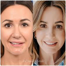 young woman with bell’s palsy

