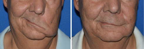 facial paralysis
