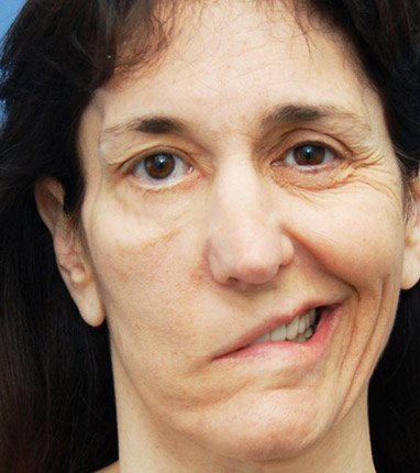 Woman Facial Paralysis
