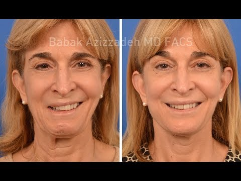 Before & After for Bell's Palsy
