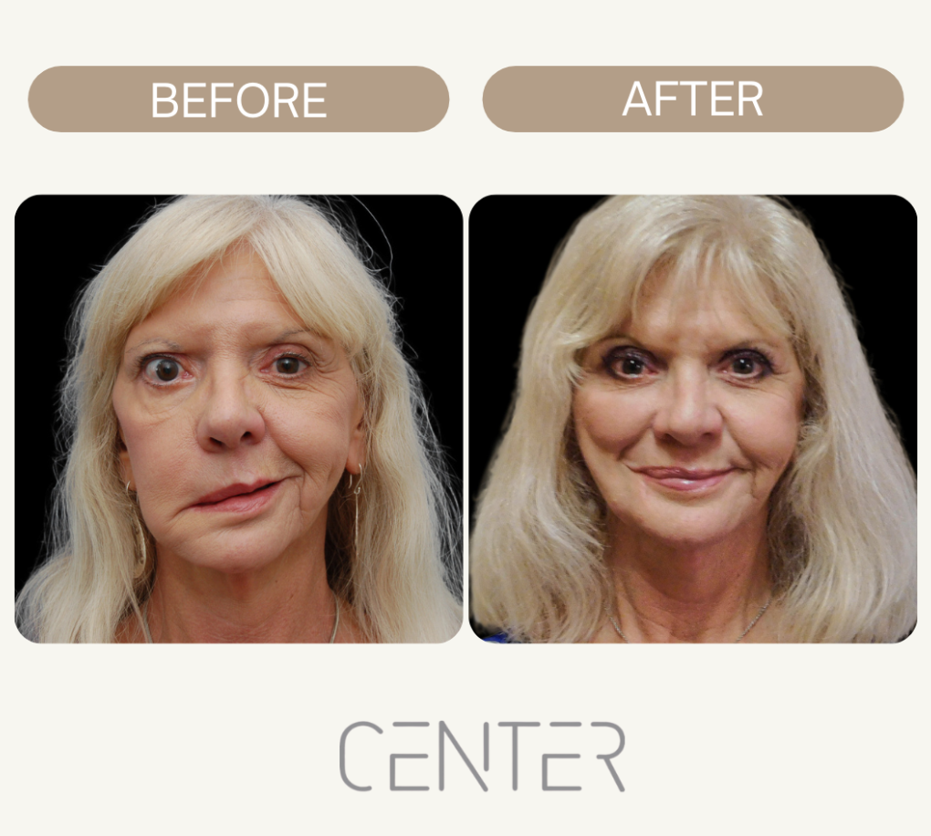 Old Woman Result of Facial Reanimation