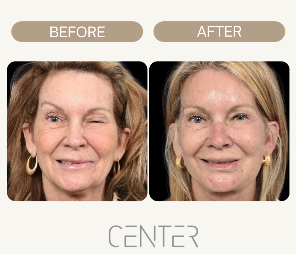 Before and After Result of Synkinesis Procedure