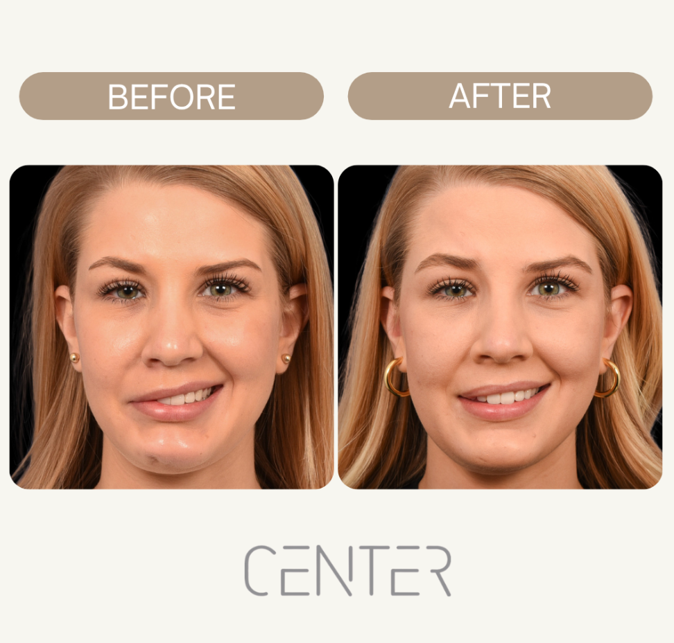 Before and After Bell's Palsy Treatment