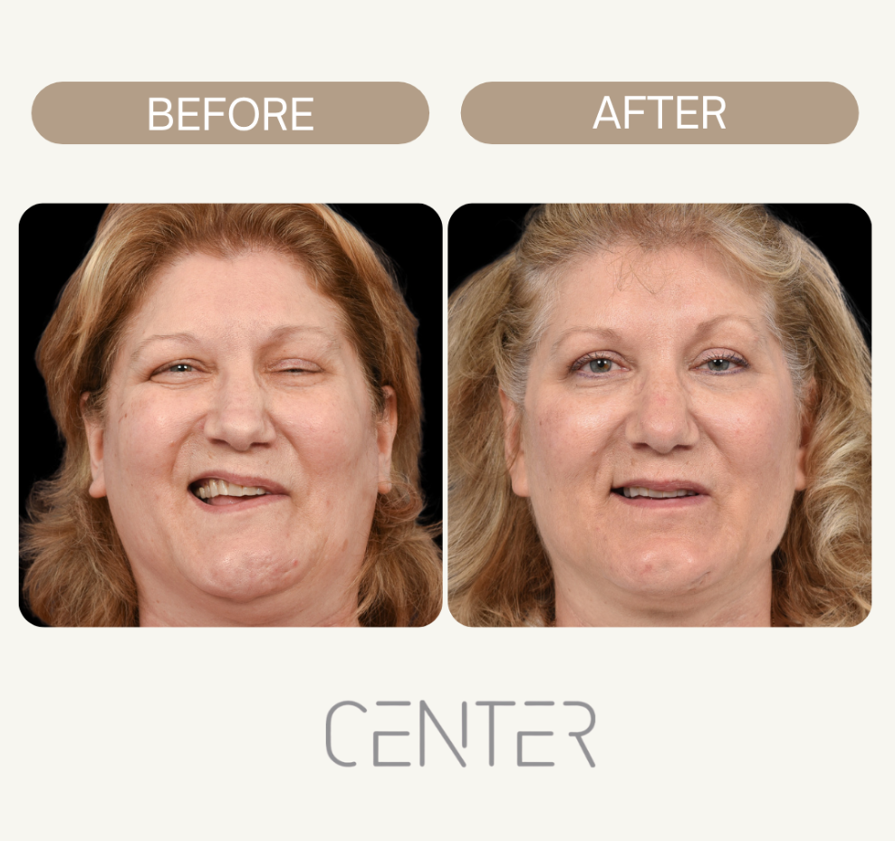 Selective Neurolysis (Synkinesis) Before and After