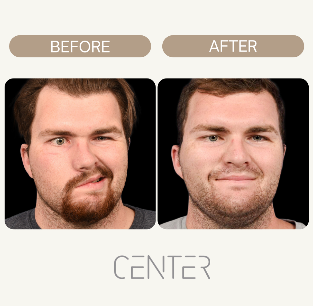 Restored Facial Symmetry of A Man