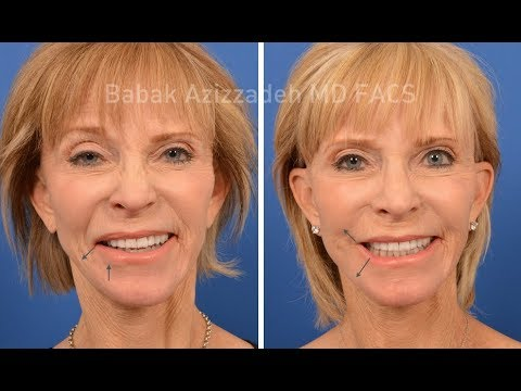 Woman Before & After Selective Neurolysis for Bell's Palsy