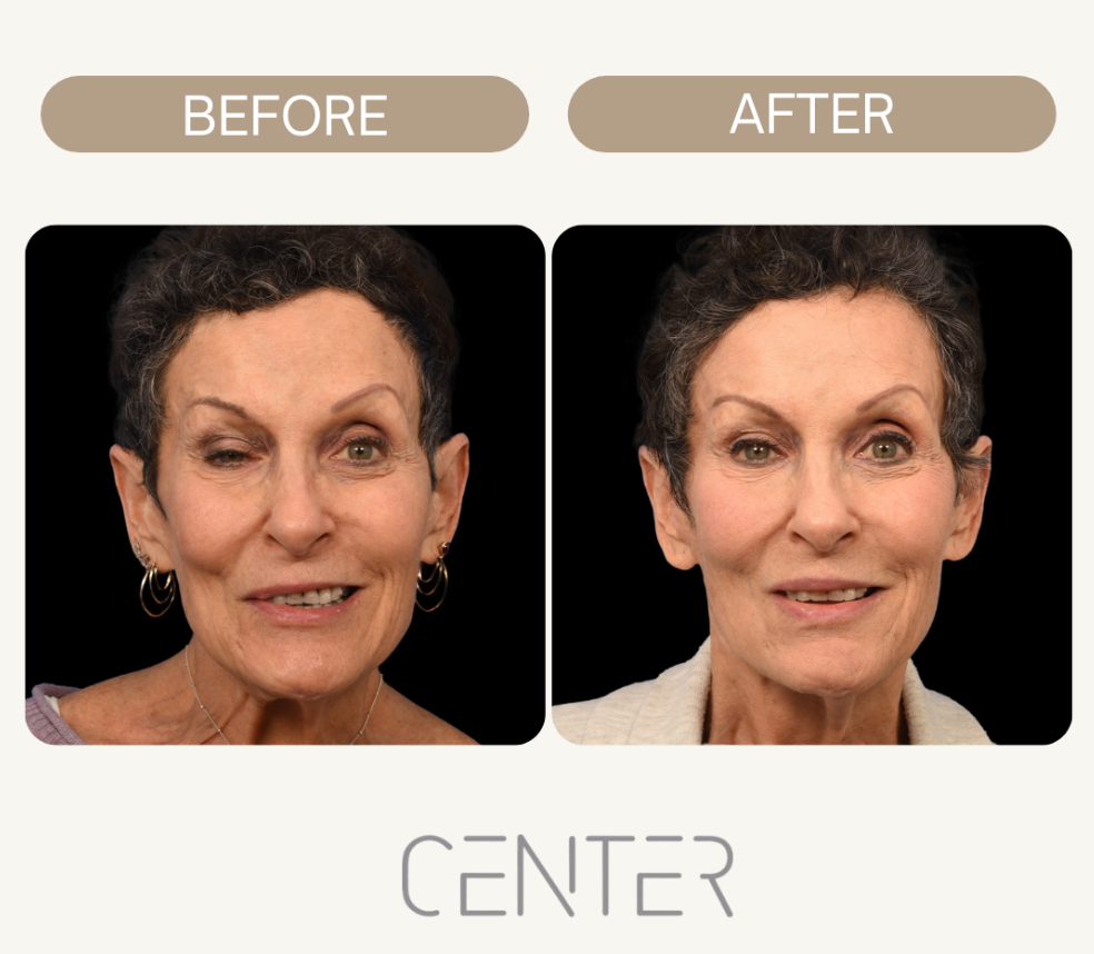 Woman before and after Selective Neurolysis Surgery