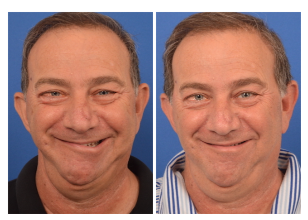  Botox for congenital unilateral lower lip palsy