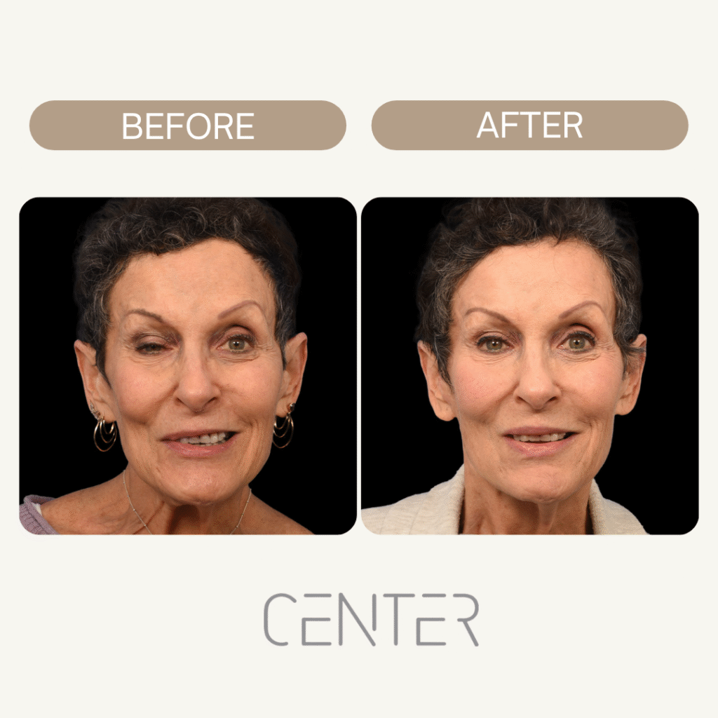 Woman with Bell’s Palsy Before and After Surgery 