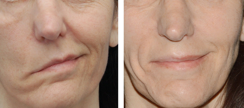 close up of a face before and after treatment of bell’s palsy