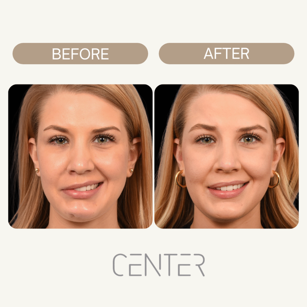 facial synkinesis before and after