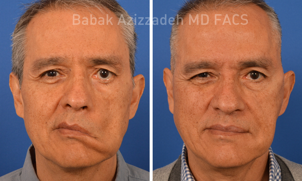 masseter to trigeminal facial nerve transfer