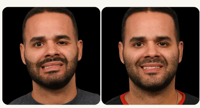 man’s face before and after facial reanimation