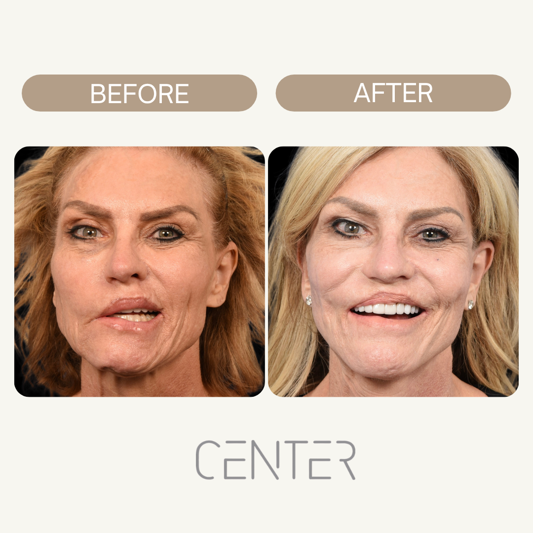 before and after bell’s palsy treatment
