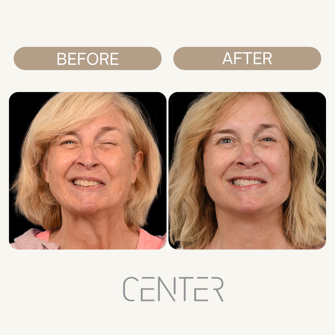 eye reconstruction before and after photo Image Source