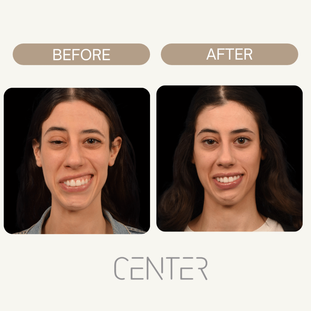 before and after bell’s palsy treatment