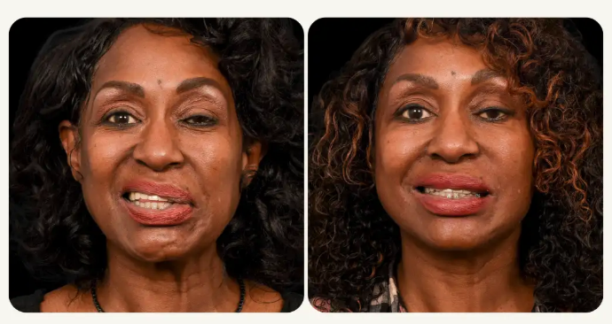 before and after facial reanimation