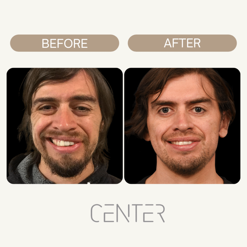 man’s face with facial paralysis  before after