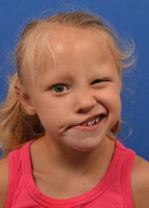  little girl with facial paralysis