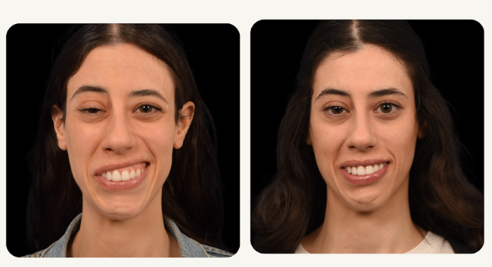  woman before and after facial reanimation