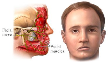 a middle-aged man with Bell's palsy