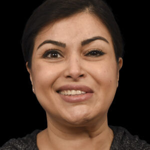 Before Facial Reanimation: Selective Neurolysis for Synkinesis and Facial Paralysis