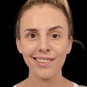 After Revision Selective Neurolysis: Advanced Facial Reanimation for Synkinesis