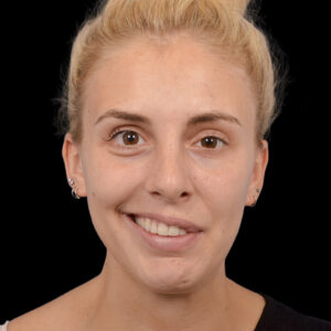 Before Revision Selective Neurolysis: Advanced Facial Reanimation for Synkinesis