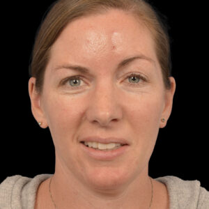 After Left Selective Neurolysis With Orbicularis Myectomy and Upper Blepharoplasty