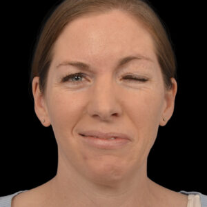 Before Left Selective Neurolysis With Orbicularis Myectomy and Upper Blepharoplasty