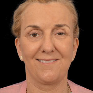 After Selective neurolysis with facial rejuvenation