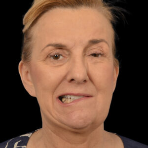 Before Selective neurolysis with facial rejuvenation