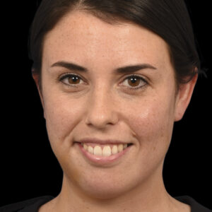 After Asymmetric Crying Facies Correction: Permanent Facial Reanimation Surgery for Congenital Unilateral Lower Lip Palsy