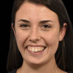 Before Asymmetric Crying Facies Correction: Permanent Facial Reanimation Surgery for Congenital Unilateral Lower Lip Palsy