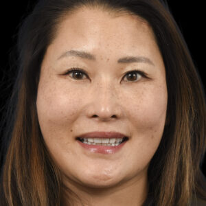 After Facial Reanimation: Left Brow Lift and Selective Neurolysis After Brain Tumor - Meningioma Surgery