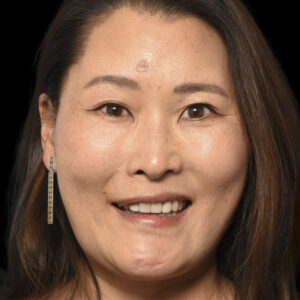 Before Facial Reanimation: Left Brow Lift and Selective Neurolysis After Brain Tumor - Meningioma Surgery