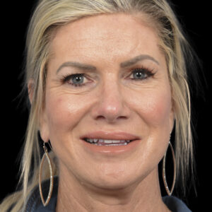 After Asymmetric Crying Facies Correction: Permanent Facial Reanimation Surgery for Congenital Unilateral Lower Lip Palsy