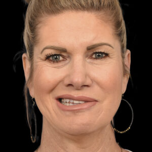 Before Asymmetric Crying Facies Correction: Permanent Facial Reanimation Surgery for Congenital Unilateral Lower Lip Palsy