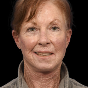 After Left Facial Paralysis and Synkinesis Correction: Selective Neurolysis + Symmetrical Facial Repositioning