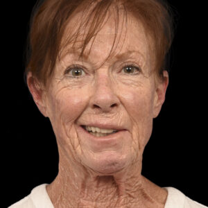 Before Left Facial Paralysis and Synkinesis Correction: Selective Neurolysis + Symmetrical Facial Repositioning