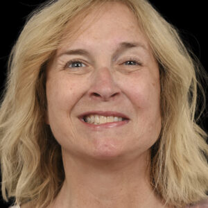 After Left Facial Paralysis and Synkinesis Correction: Selective Neurolysis, Deep Plane Facelift & Platysma Myectomy