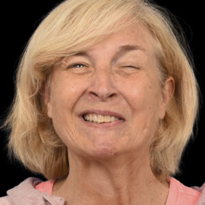 Before Left Facial Paralysis and Synkinesis Correction: Selective Neurolysis, Deep Plane Facelift & Platysma Myectomy