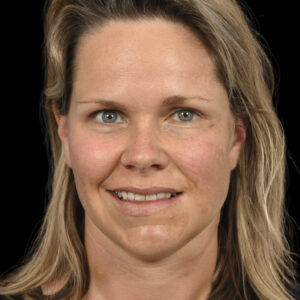 After Left Facial Paralysis and Synkinesis due to Facial Hemangioma: Selective Neurolysis, Brow Lift & Deep Plane Facelift