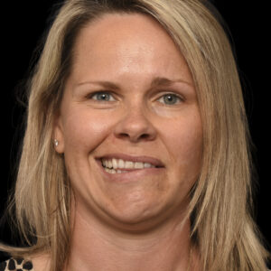 Before After Left Facial Paralysis and Synkinesis due to Facial Hemangioma: Selective Neurolysis, Brow Lift & Deep Plane Facelift