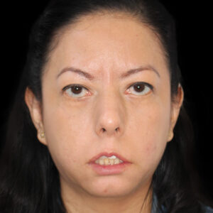 Before Left Facial Paralysis and Synkinesis due to Facial Hemangioma: Selective Neurolysis, Brow Lift & Deep Plane Facelift