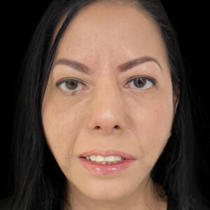 After Left Facial Paralysis and Synkinesis due to Facial Hemangioma: Selective Neurolysis, Brow Lift & Deep Plane Facelift